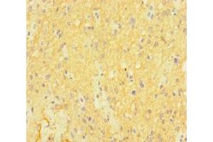 Immunohistochemistry of paraffin-embedded human glioma using ABIN7146992 at dilution of 1:100 (CTNND2 antibody  (AA 4-308))