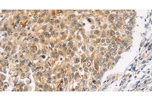 Immunohistochemistry of paraffin-embedded Human lung cancer using JNK2 Polyclonal Antibody at dilution of 1:30 (JNK2 antibody)