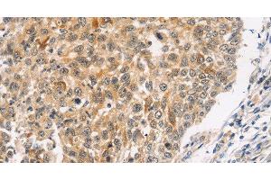 Immunohistochemistry of paraffin-embedded Human lung cancer using JNK2 Polyclonal Antibody at dilution of 1:30 (JNK2 antibody)