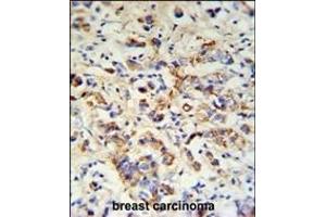 DCT Antibody (N-term) (ABIN653914 and ABIN2843150) IHC analysis in formalin fixed and paraffin embedded breast carcinoma followed by peroxidase conjugation of the secondary antibody and DAB staining. (DCT antibody  (N-Term))