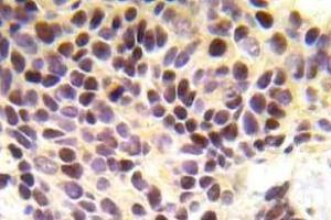 Immunohistochemistry (IHC) analyzes of BRCA1 pAb in paraffin-embedded human breast carcinoma tissue. (BRCA1 antibody)