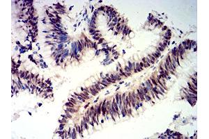 Immunohistochemical analysis of paraffin-embedded colon cancer tissues using CIRBP mouse mAb with DAB staining.