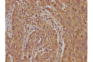 IHC image of ABIN7158062 diluted at 1:100 and staining in paraffin-embedded human cervical cancer performed on a Leica BondTM system. (LRTM2 antibody  (AA 36-310))