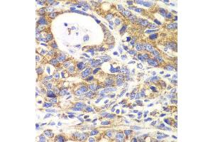 Immunohistochemistry of paraffin-embedded human gastric cancer using GLUD2 antibody at dilution of 1:100 (x40 lens). (GLUD2 antibody)