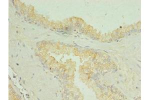 Immunohistochemistry of paraffin-embedded human prostate cancer using ABIN7169990 at dilution of 1:100 (SLC34A2 antibody  (AA 574-689))