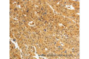 Immunohistochemistry of Human ovarian cancer using AKR1A1 Polyclonal Antibody at dilution of 1:25 (AKR1A1 antibody)