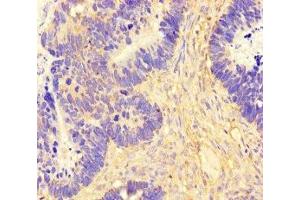 Immunohistochemistry of paraffin-embedded human ovarian cancer using ABIN7165554 at dilution of 1:100 (FAM71F2 antibody  (AA 1-300))