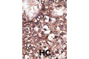 Formalin-fixed and paraffin-embedded human hepatocellular carcinoma tissue reacted with LRP8 polyclonal antibody  , which was peroxidase-conjugated to the secondary antibody, followed by DAB staining. (LRP8 antibody  (AA 934-963))