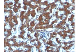 Formalin-fixed, paraffin-embedded human Hepatocellular Carcinoma stained with RBP1 Mouse Monoclonal Antibody (G4E4). (RBP4 antibody)