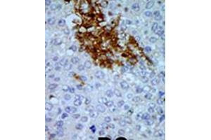 Formalin-fixed and paraffin-embedded human cancer tissue reacted with the primary antibody, which was peroxidase-conjugated to the secondary antibody, followed by AEC staining. (PNCK antibody  (C-Term))