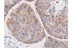 Immunohistochemical staining of paraffin-embedded Adenocarcinoma of Human breast tissue using anti-LCMT1 mouse monoclonal antibody. (LCMT1 antibody)