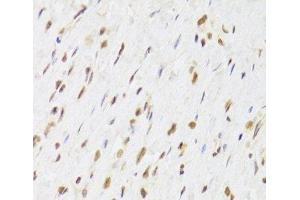 Immunohistochemistry of paraffin-embedded Human gastric cancer using RUVBL1 Polyclonal Antibody at dilution of 1:100 (40x lens). (RUVBL1 antibody)