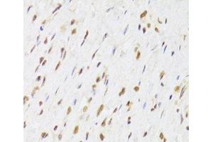 Immunohistochemistry of paraffin-embedded Human gastric cancer using RUVBL1 Polyclonal Antibody at dilution of 1:100 (40x lens).