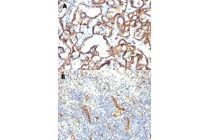 Immunohistochemical staining (Formalin-fixed paraffin-embedded sections) of human angiosarcoma (A) and human tonsil (B) with CD34 monoclonal antibody, clone HPCA1/1171 . (CD34 antibody)
