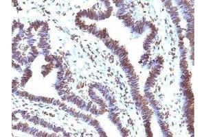 Formalin-fixed, paraffin-embedded human ovarian carcinoma stained with EMI1 antibody (EMI1/1176). (FBXO5 antibody  (AA 1-250))