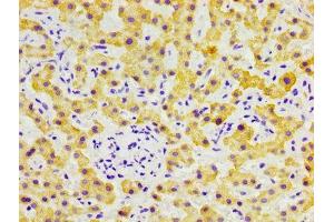 IHC image of ABIN7152767 diluted at 1:300 and staining in paraffin-embedded human liver cancer performed on a Leica BondTM system. (FGL1 antibody  (AA 179-282))