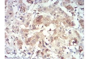 Immunohistochemical analysis of paraffin-embedded liver cancer tissues using PRDM4 mouse mAb with DAB staining.