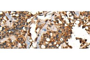Immunohistochemistry of paraffin-embedded Human ovarian cancer tissue using SHPK Polyclonal Antibody at dilution of 1:45(x200) (SHPK antibody)