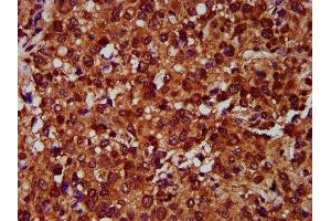 IHC image of ABIN7151929 diluted at 1:400 and staining in paraffin-embedded human glioma performed on a Leica BondTM system. (EMP2 antibody  (AA 22-66))