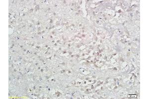 Formalin-fixed and paraffin embedded human hepatoma labeled with Anti-LAMP-3/DC-LAMP/CD208 Polyclonal Antibody, Unconjugated (ABIN742005) at 1:300 followed by conjugation to the secondary antibody and DAB (LAMP3 antibody  (AA 301-416))