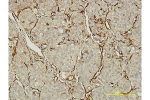 Immunoperoxidase of monoclonal antibody to PECAM1 on formalin-fixed paraffin-embedded human lung, adenosquamous cell carcinoma tissue. (CD31 antibody  (AA 29-738))
