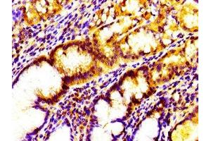 Immunohistochemistry of paraffin-embedded human gastric cancer using ABIN7156813 at dilution of 1:100 (IL17D antibody  (AA 16-202))