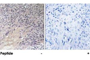 Immunohistochemical analysis of paraffin-embedded human cervix carcinoma tissue using ARHGDIA polyclonal antibody . (ARHGDIA antibody)