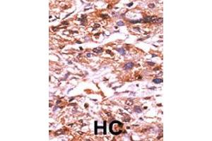 Formalin-fixed and paraffin-embedded human hepatocellular carcinoma tissue reacted with CDC25A (phospho S124) polyclonal antibody  which was peroxidase-conjugated to the secondary antibody followed by AEC staining. (CDC25A antibody  (pSer124))