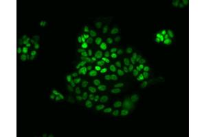 Immunofluorescent staining of human colorectal adenocarcinoma. (CDX2 antibody)