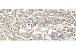 Immunohistochemistry of paraffin-embedded Human lung cancer tissue using DMC1 Polyclonal Antibody at dilution of 1:30(x200) (DMC1 antibody)