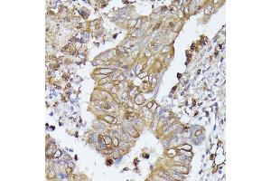 Immunohistochemistry of paraffin-embedded human colon carcinoma using CD52 antibody (ABIN7266207) at dilution of 1:100 (40x lens). (CD52 antibody  (AA 1-61))