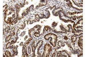 Immunohistochemical analysis of paraffin-embedded Human Ovarian cancer section using Pink1 (ABIN1882273 and ABIN2838445). (PCNA antibody  (C-Term))