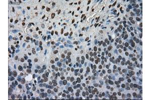 Immunohistochemical staining of paraffin-embedded Adenocarcinoma of colon tissue using anti-MKI67mouse monoclonal antibody. (Ki-67 antibody  (AA 1-250))