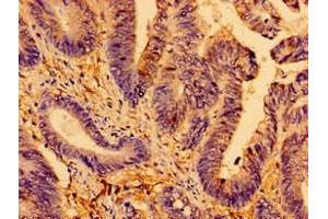 Immunohistochemistry of paraffin-embedded human colon cancer using ABIN7144021 at dilution of 1:100 (AMPD2 antibody  (AA 1-129))