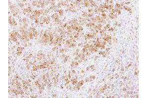 IHC-P Image Immunohistochemical analysis of paraffin-embedded SCM1 xenograft, using PABPC3, antibody at 1:100 dilution. (PABPC3 antibody)