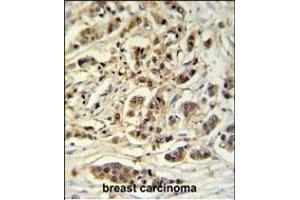 M11D1 Antibody (N-term) (ABIN653932 and ABIN2843164) IHC analysis in formalin fixed and paraffin embedded breast carcinoma followed by peroxidase conjugation of the secondary antibody and DAB staining. (METTL17 antibody  (N-Term))