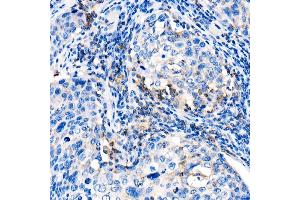 Immunohistochemistry of paraffin-embedded human cervix cancer using IL22 Rabbit pAb (ABIN6128134, ABIN6142363, ABIN6142364 and ABIN6221808) at dilution of 1:1000 (40x lens).