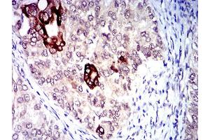 Immunohistochemical analysis of paraffin-embedded cervical cancer tissues using CD183 mouse mAb with DAB staining.