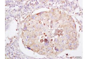Formalin-fixed and paraffin embedded human lung carcinoma labeled with Anti-LRRC25 Polyclonal Antibody, Unconjugated  at 1:200 followed by conjugation to the secondary antibody and DAB staining