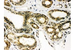IHC(P): Human Mammary Cancer Tissue (Peroxiredoxin 6 antibody  (AA 15-224))