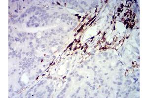 Immunohistochemical analysis of paraffin-embedded rectum cancer tissues using CD45 mouse mAb with DAB staining. (CD45 antibody  (AA 431-577))