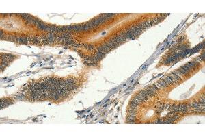 Immunohistochemistry of paraffin-embedded Human colon cancer tissue using CIB1 Polyclonal Antibody at dilution 1:30 (CIB1 antibody)