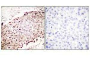 Immunohistochemistry analysis of paraffin-embedded human breast carcinoma tissue using Sumo1 antibody. (SUMO1 antibody  (N-Term))