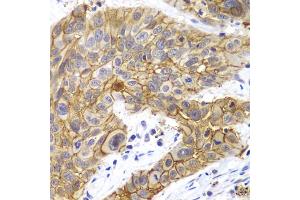 Immunohistochemistry of paraffin-embedded human lung cancer using CLDN1 antibody. (Claudin 1 antibody)