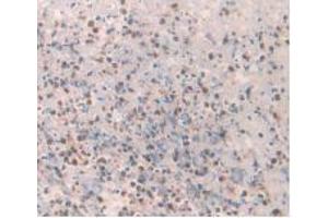IHC-P analysis of Human Rectum Cancer Tissue, with DAB staining. (Amylin/DAP antibody)