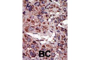 Formalin-fixed and paraffin-embedded human cancer tissue reacted with DGKA polyclonal antibody  , which was peroxidase-conjugated to the secondary antibody, followed by AEC staining. (DGKA antibody  (C-Term))