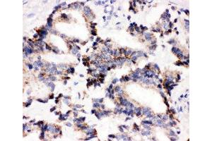 IHC-P: IRAK2 antibody testing of human lung cancer tissue (IRAK2 antibody  (C-Term))