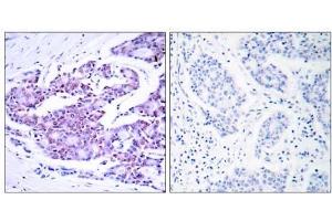Immunohistochemical analysis of paraffin- embedded human breast carcinoma tissue using NF-κB p65 (Ab-468) antibody (E021013). (NF-kB p65 antibody)