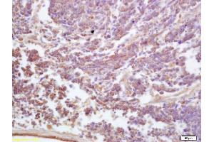 Formalin-fixed and paraffin embedded human lung carcinoma labeled with Anti-ADAM19 Polyclonal Antibody, Unconjugated (ABIN758801) at 1:200 followed by conjugation to the secondary antibody and DAB staining (ADAM19 antibody  (AA 251-350))