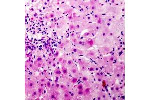 Immunohistochemical analysis of CEP110 staining in human liver cancer formalin fixed paraffin embedded tissue section. (Centriolin antibody  (C-Term))
